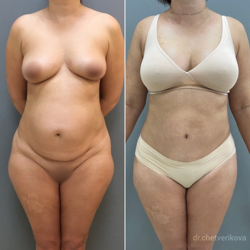 Пациентка пластического хирурга Марины Четвериковой до и после подтяжки живота и липосакции в СПб