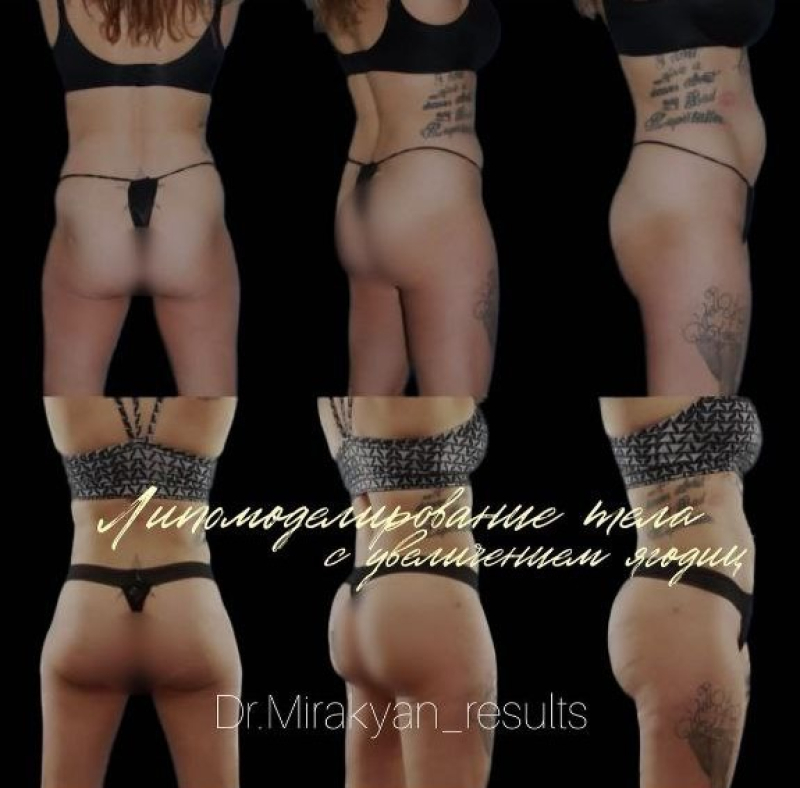  Пациентка пластического хирурга Гукаса Миракяна. Фото до и после липофилинга ягодиц