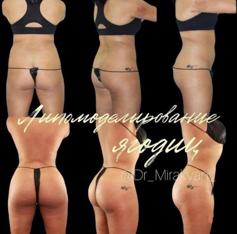  Пациентка пластического хирурга Гукаса Миракяна. Фото до и после липофилинга ягодиц