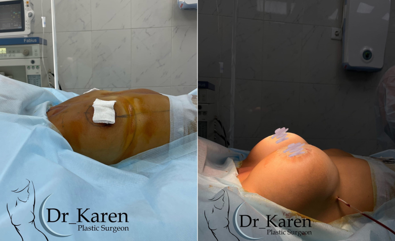 Пациентка пластического хирурга Карена Пайтяна. Фото до и после увеличения груди имплантами сразу после операции