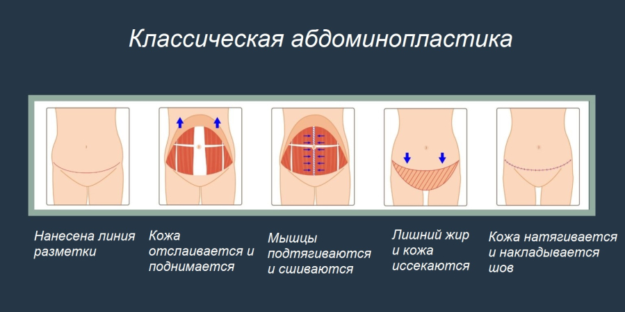 Как проводится классическая абдоминопластика
