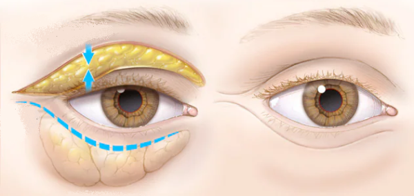 Жировые грыжи и мешки под глазами