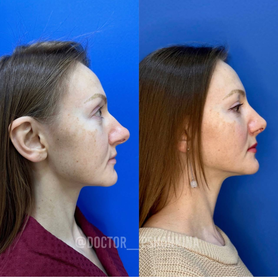 Пациентка доктора Пшонкиной до и после ринопластики без остеотомии