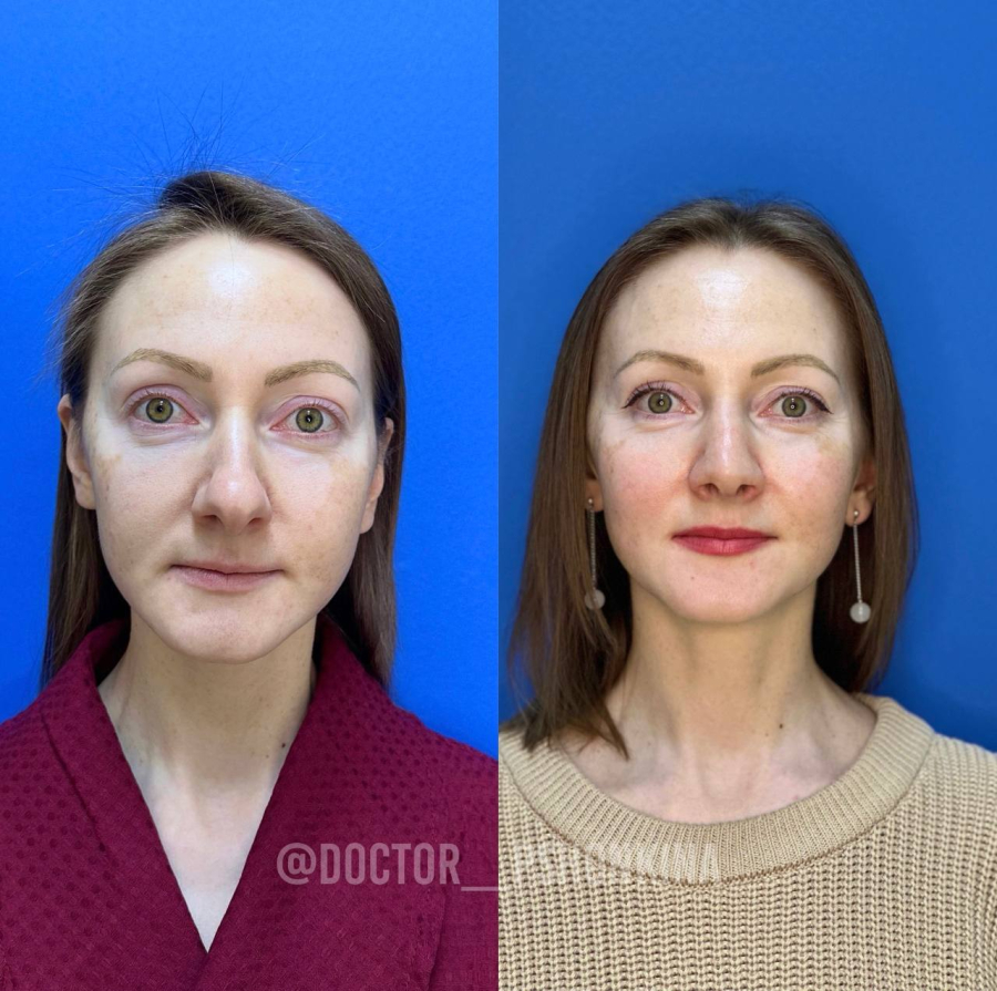 Пациентка доктора Светланы Пшонкиной до и после ринопластики без остеотомии