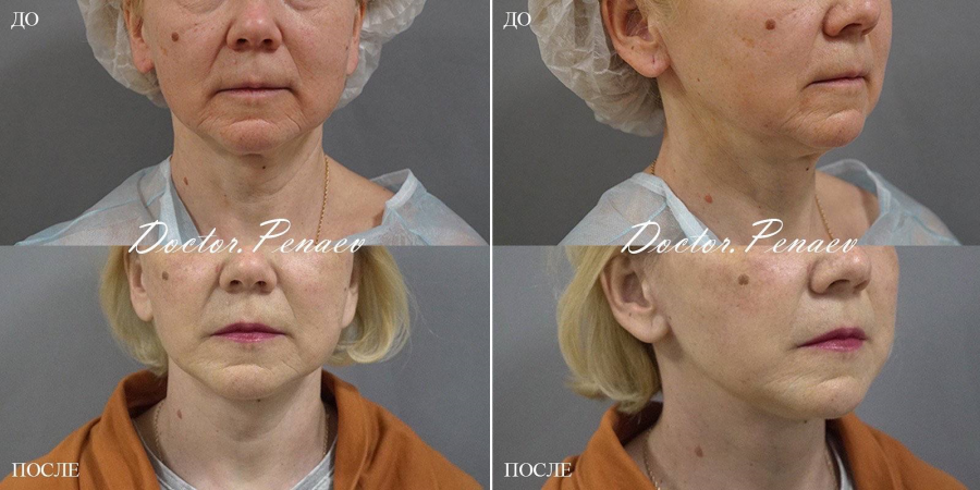 Пациентка доктора А.А. Пенаева, 54 года. Выполнено омоложение с помощью SMAS-пластики лица с ультразвуковой диссекцией тканей по авторской методике