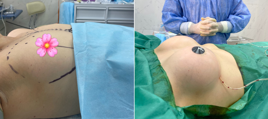 Пациентка доктора Пайтяна до и после увеличения груди.