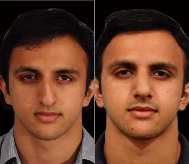 Фото пациента до и после ринопластики. Оперирующий хирург – доктор Гукас Миракян
