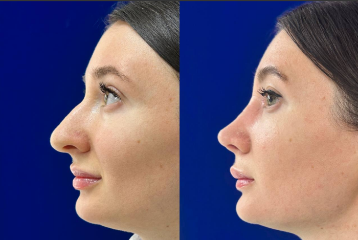 Пациентка доктора Гайка Бабаяна до и после ринопластики