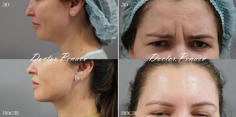Пациентка пластического хирурга Арслана Пенаева до и после комплексной пластики лица