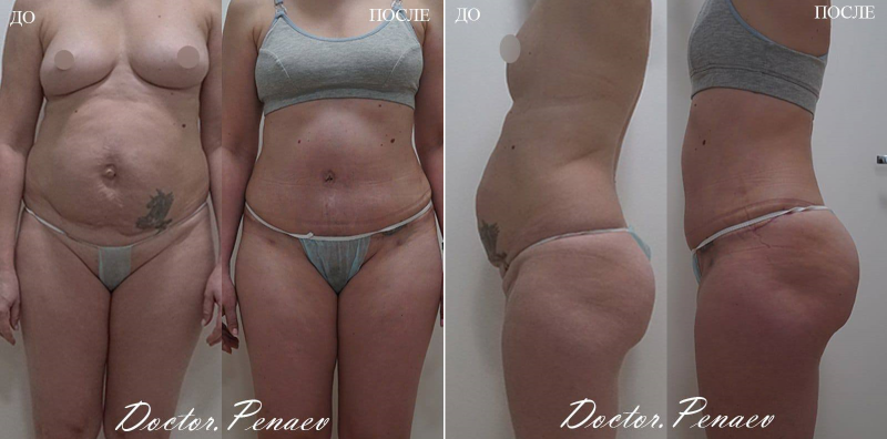 Пациентка профессора Арслана Пенаева до и после одномоментной липосакции VASER и подтяжки живота.