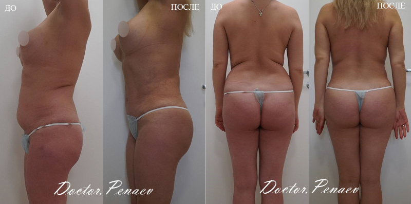 Пациентка профессора Арслана Пенаева до и после комплексного липомоделирования тела.