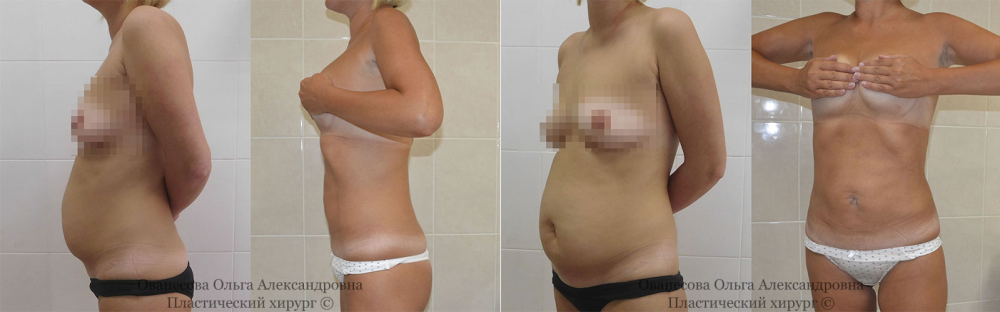 Пациентка доктора Ольги Ованесовой до и после липосакции
