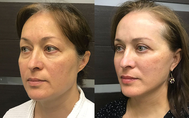  Пациентка хирурга Ованесовой О.А. Фото до и после комплексного омоложения.