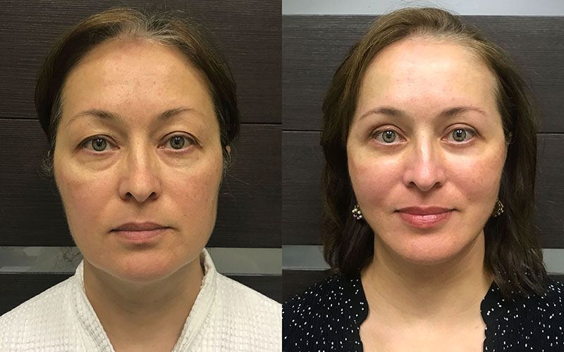  Пациентка доктора Ованесовой О.А. Фото до и после комплексного омоложения.