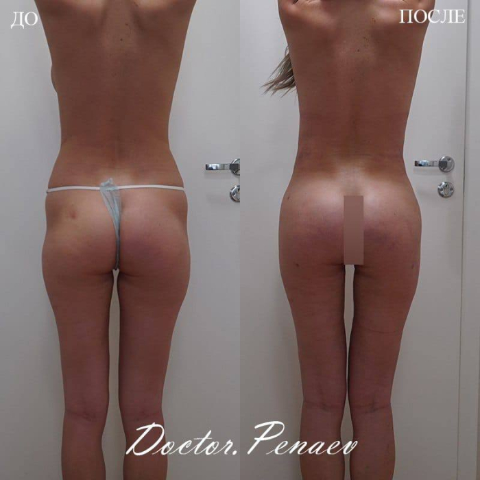 Пациентка доктора Арслана Пенаева до и после липосакции и увеличения ягодиц