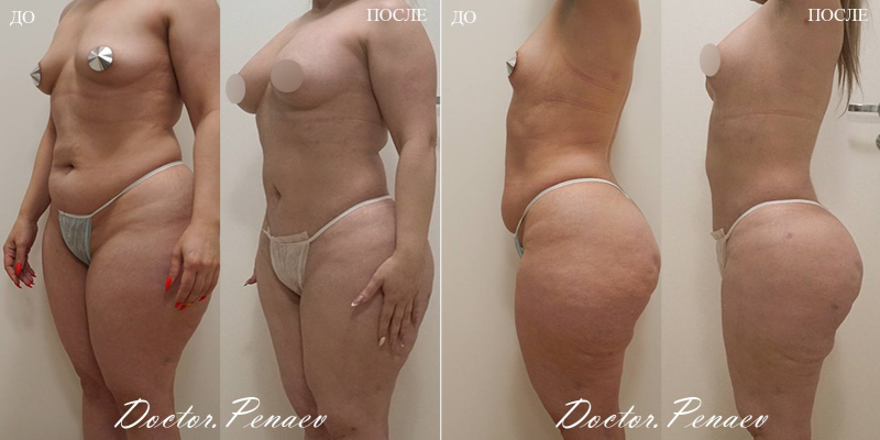 Пациентка до и после вазер липосакции и липотрансфера ягодиц