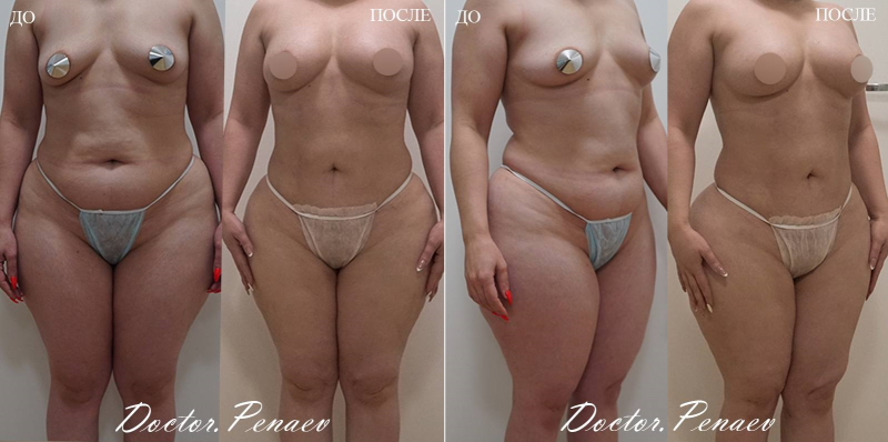 Пациентка до и после вазер липосакции и липотрансфера