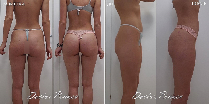Пациентка до и после вазер липосакции тела