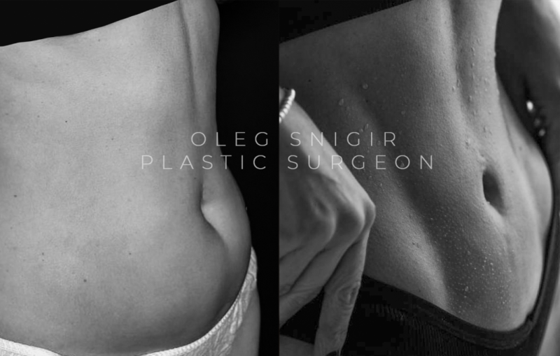Пациентка пластического хирурга Олега Снигиря до и после спортивного липомоделирования живота и боков