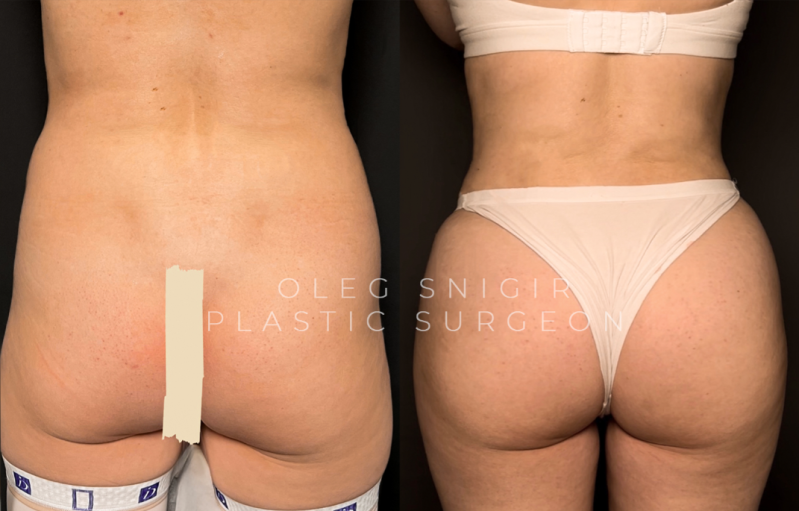 Пациентка пластического хирурга Олега Снигиря. Доктором было выполнено спортивное липомоделирование