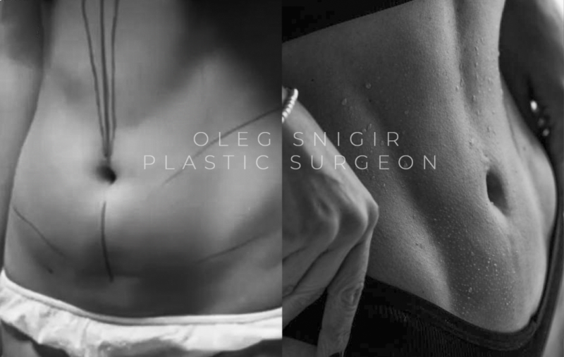 Пациентка пластического хирурга Олега Снигиря до и после спортивного липомоделирования живота и боков
