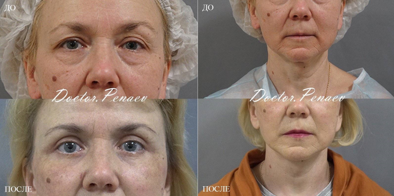 Пациентка (54 года) доктора Арслана Пенаева. Фото до и после смас-пластики лица