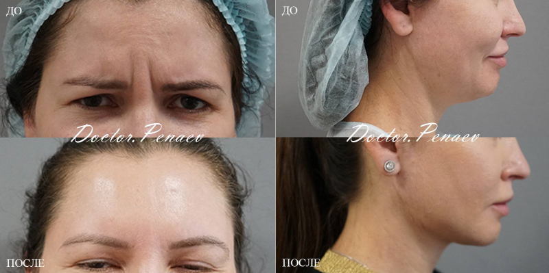 Пациентка (38 лет) доктора Арслана Пенаева. Фото до и после малоинвазивного омоложения лица