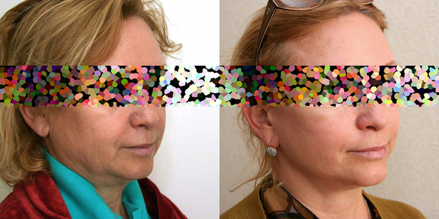 Пациентка пластического хирурга Александра Жукова до и после омолаживающей операции.