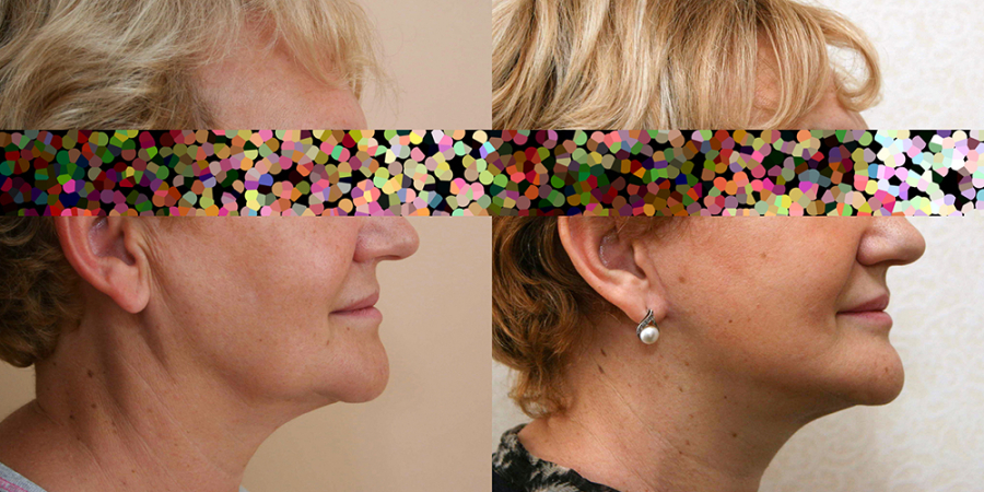 Пациентка доктора Александра Жукова до и после операции по омоложению лица