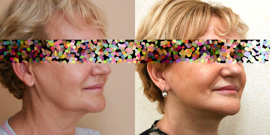 Пациентка доктора Александра Жукова до и после операции по омоложению лица