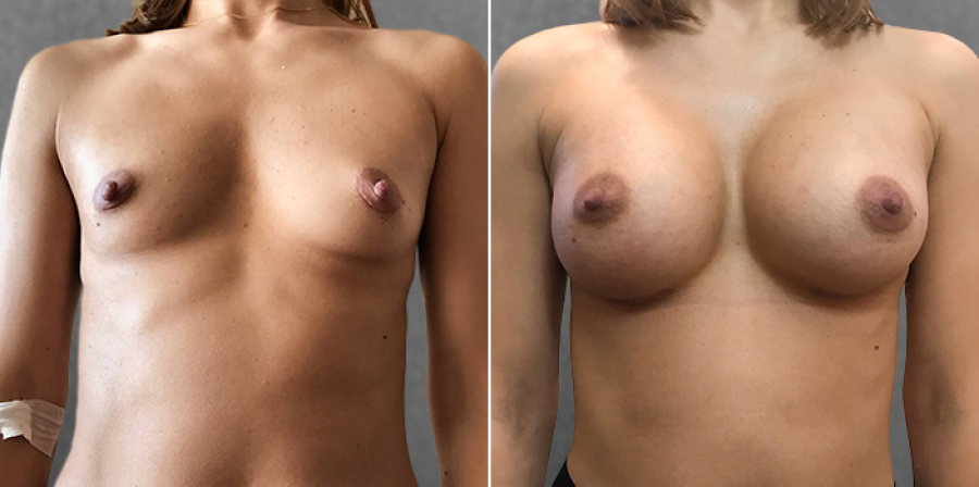 Пациентка пластического хирурга Дмитрия Крысина до и после увеличения груди имплантатами