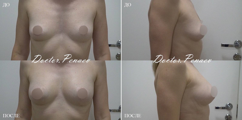 Пациентка пластического хирурга Арслана Пенаева. Фото до и после липотрансфера груди