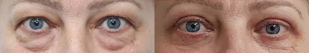 Пациентка доктора Александра Жукова на фото до и после блефаропластики.