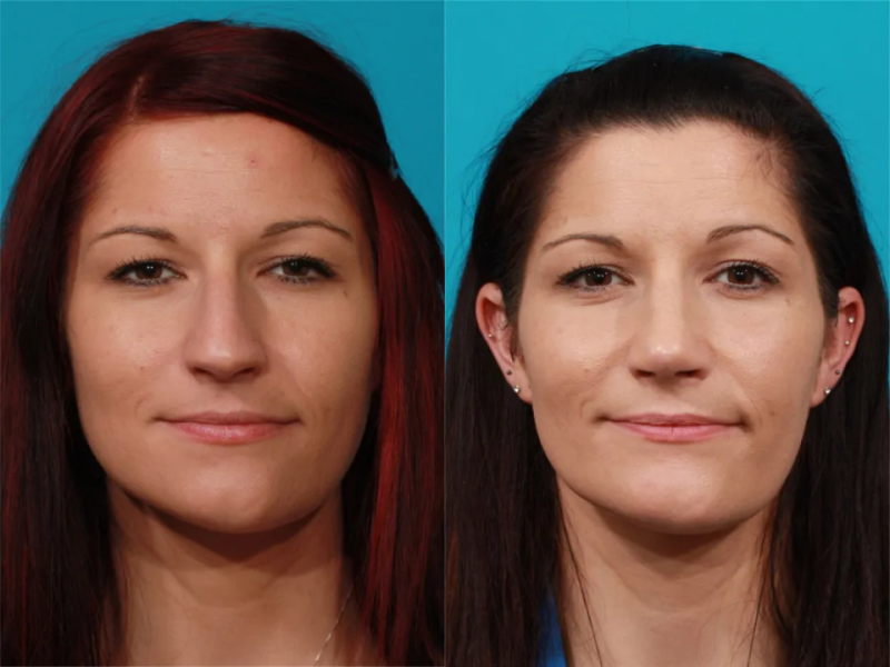 Пациентка пластического хирурга Гукаса Миракяна. Фото до и после ринопластики.