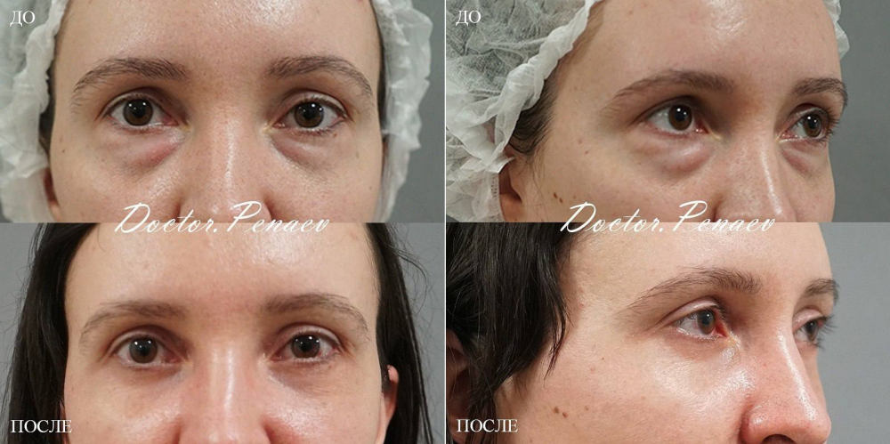 Пациентка пластического хирурга Арслана Пенаева до и после блефаропластики и лазерной шлифовки