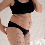 Эксперт объяснил, сколько зон можно обработать за один сеанс липосакции