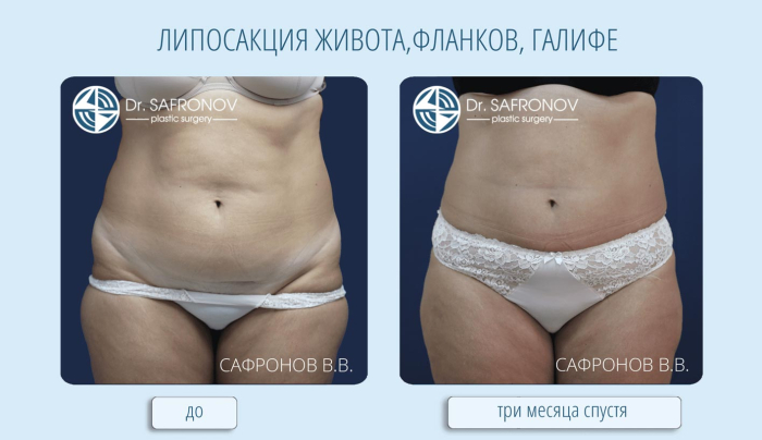 Пациентка пластического хирурга Владимира Сафронова до и после липосакции