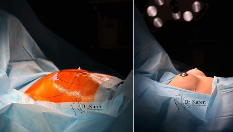 Пациентка пластического хирурга Карена Пайтяна до и после увеличивающей маммопластики