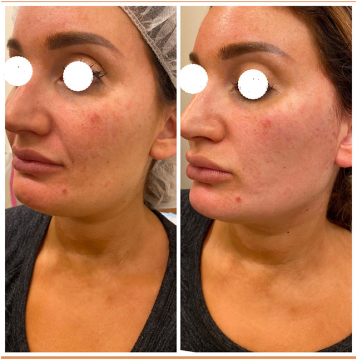 До и после проведения нитевого лифтинга PDO для разглаживания носогубных складок