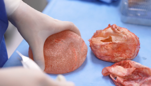 Капсулярная контрактура.