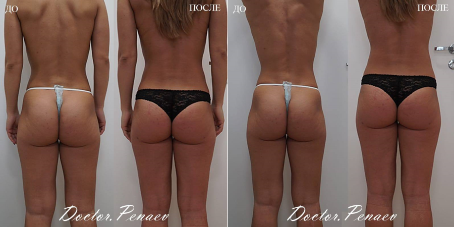 Пациентка доктора Арслана Пенаева до и после вазер-липосакции и липофилинга ягодиц