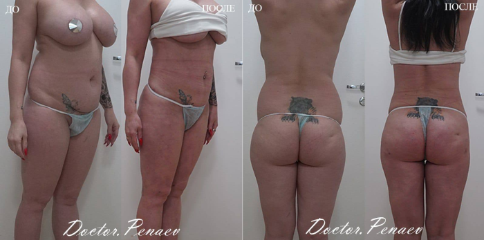 Пациентка доктора Пенаева до и после мультизональной вазер-липосакции и липофилинга ягодиц
