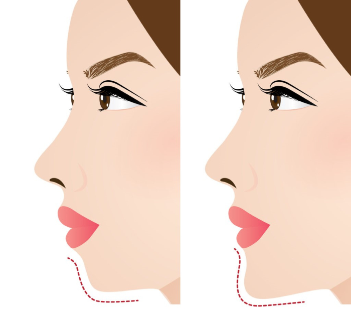 Чем поможет имплантация подбородка