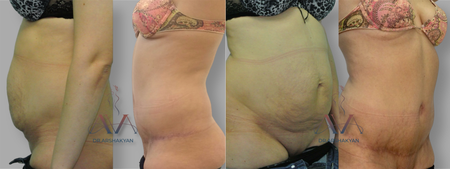 Пациентка пластического хирурга Вардана Аршакяна до и после абдоминопластики после родов