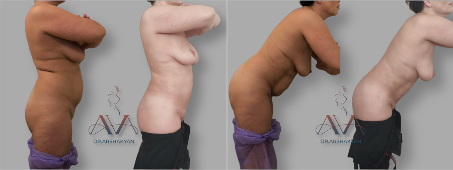 Пациентка хирурга Вардана Аршакяна до и после операции по радиочастотной липосакции Body Tite