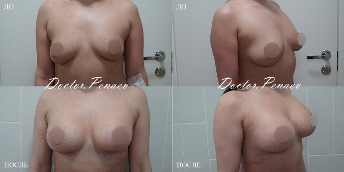 Пациентка доктора Пенаева А.А. до и после увеличения груди имплантами