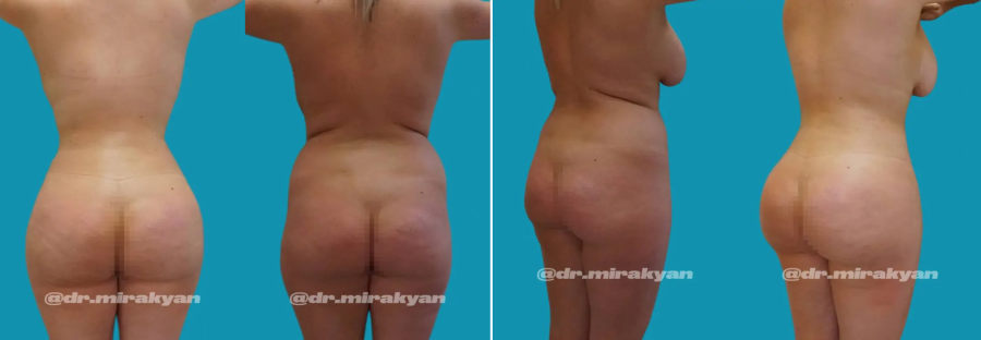 Пациентка пластического хирурга Гукаса Миракяна до и после липосакции