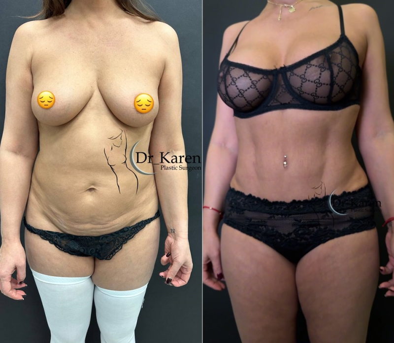 Пациентка доктора Карена Пайтяна. Фото до и после комплексной операции по проекту «POSTNATAL».