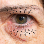 Микрохирургическая блефаропластика