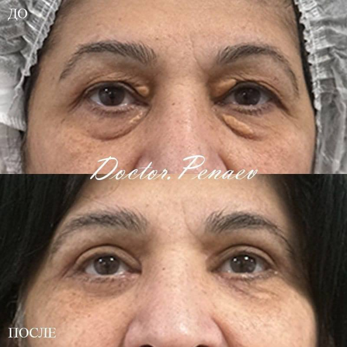 Удаление ксантомы